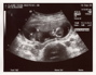 13weekUltrasound_01