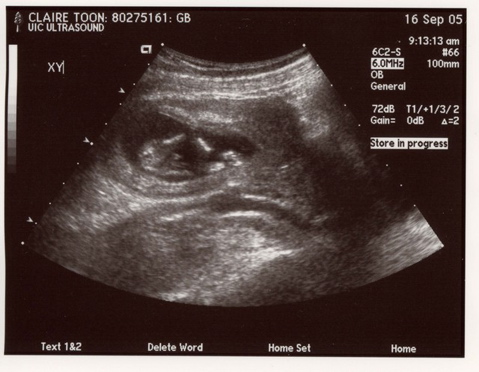 13weekUltrasound_02