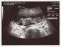 13weekUltrasound_03