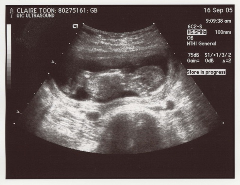 13weekUltrasound_03