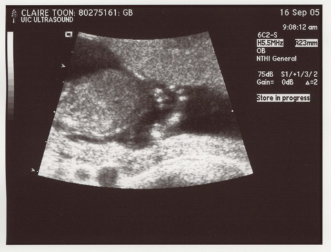 13weekUltrasound_04