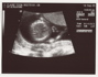 13weekUltrasound_05