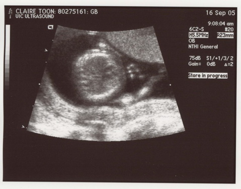 13weekUltrasound_05