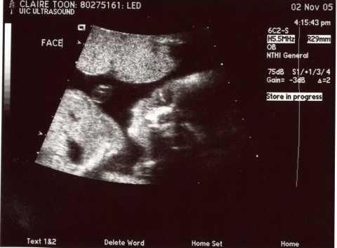 20weekUltrasound_01