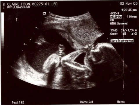 20weekUltrasound_03